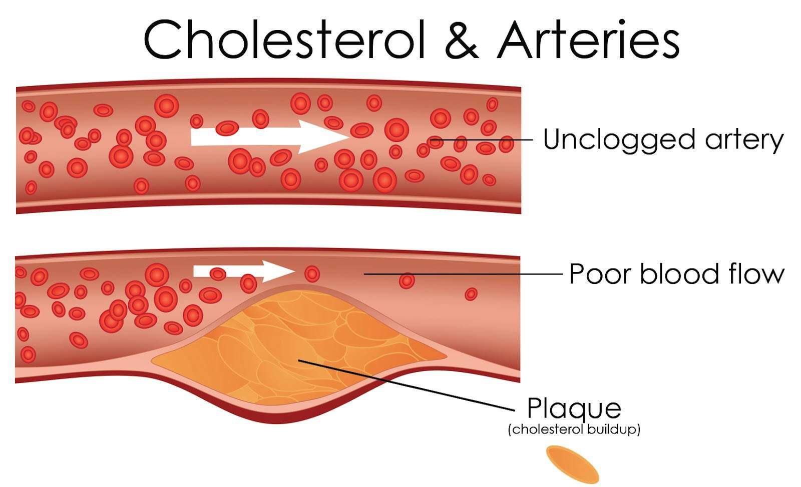 10 Symptoms of High Cholesterol &  15 Foods To Lower Bad ...