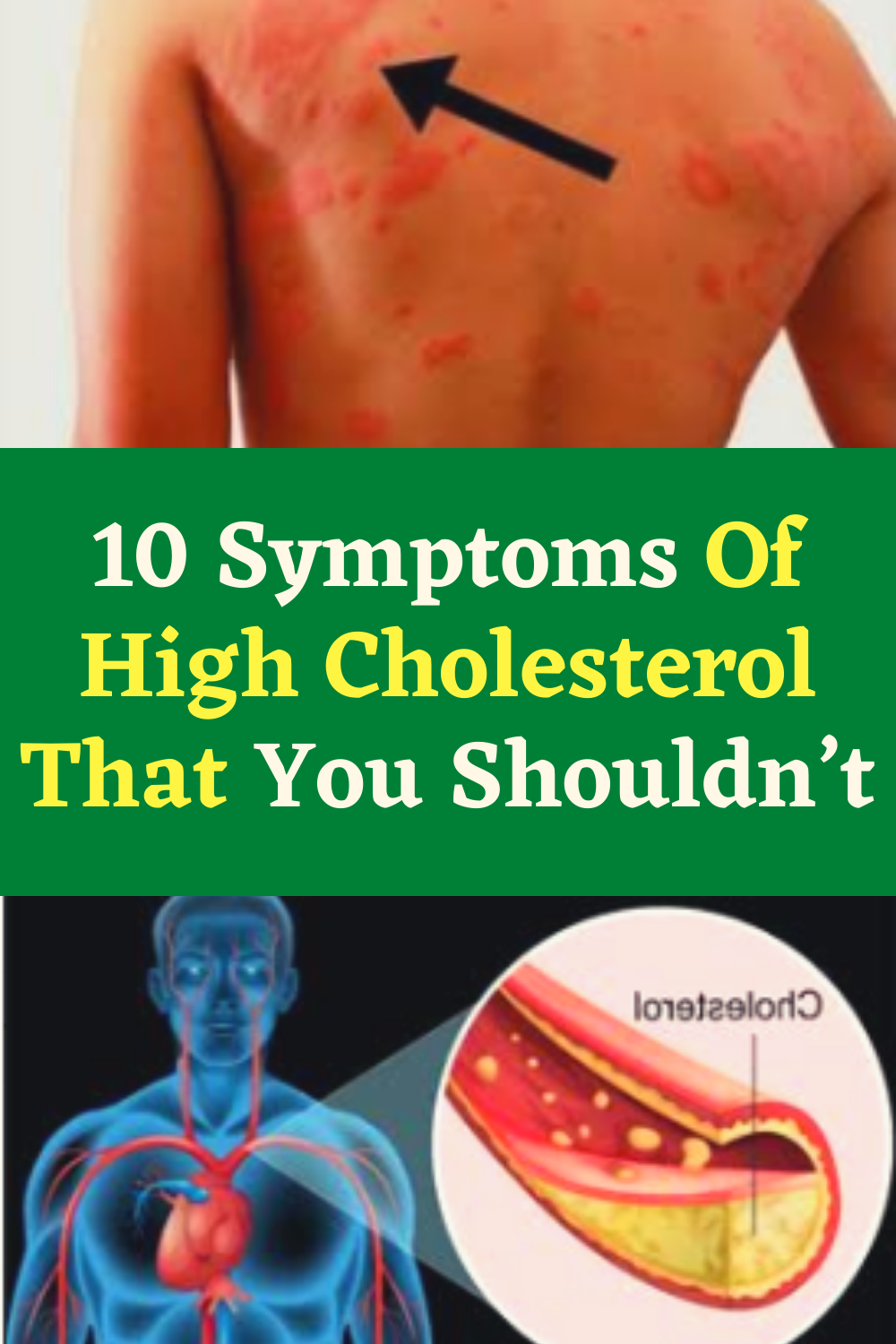10 Symptoms Of High Cholesterol That You Shouldnt