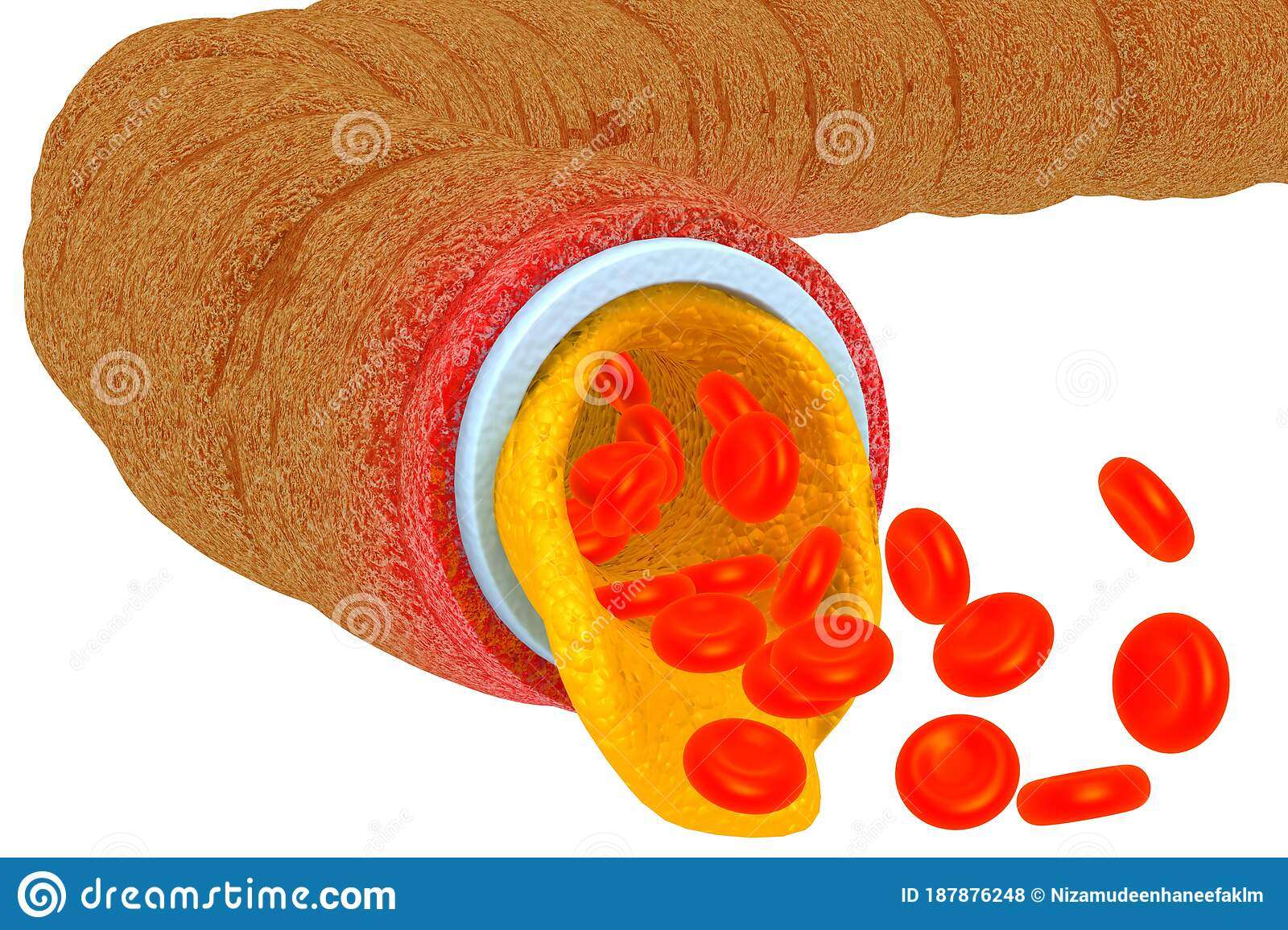 Artery Blocked With Cholesterol Stock Illustration ...