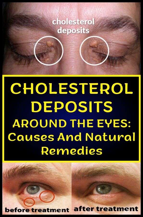 Causes And Natural Remedies For Cholesterol Deposits Around The Eyes ...