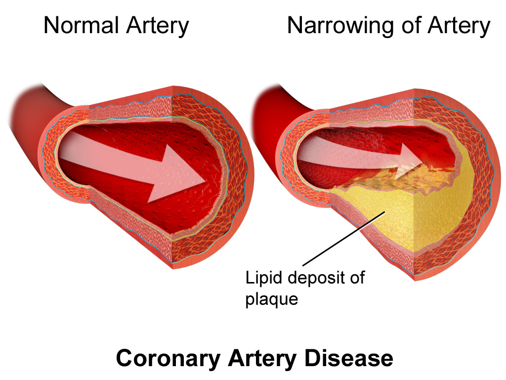 Causes And Risk Factors Of Coronary Heart Disease ...