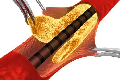 Cholesterol Plaque In Artery Removing Plaque Stock Photo ...
