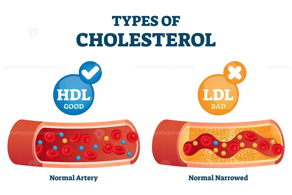 Cholesterol types comparison with HDL and LDL lipoprotein vector ...