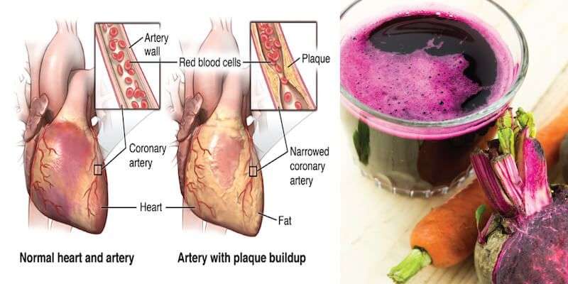 Clean Cholesterol Plaque Out of Arteries With This Juice ...
