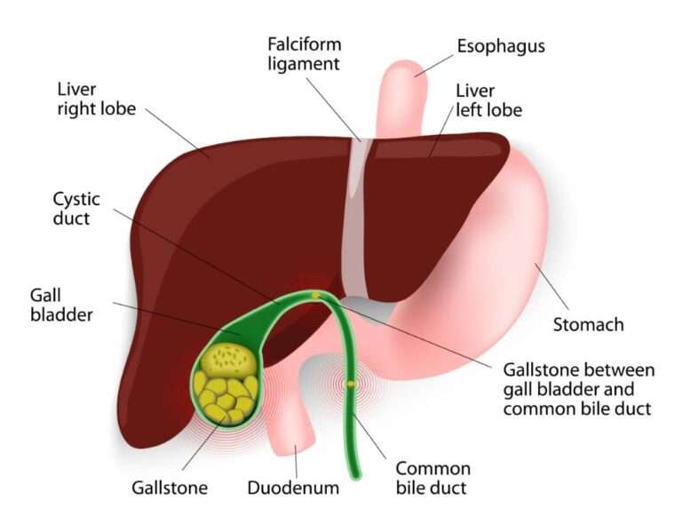 Could One of the Following 10 Conditions Be Causing Your Gallstones ...