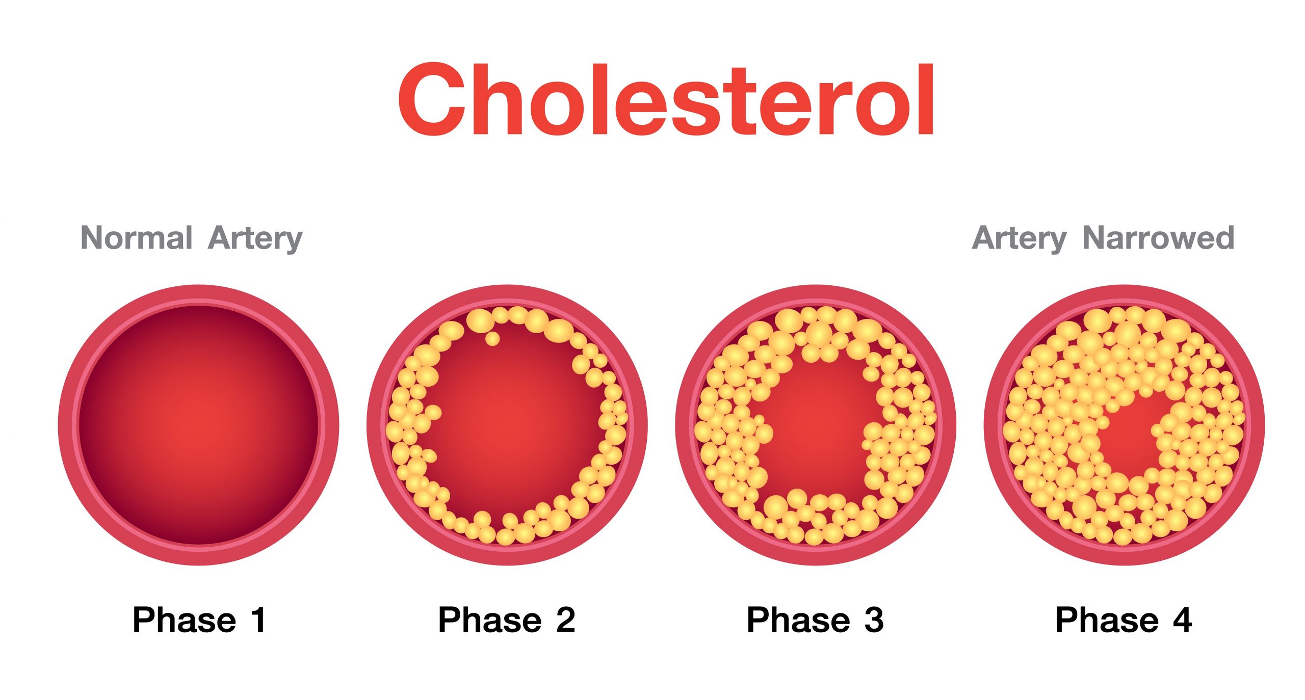 Dealing with atherosclerosis