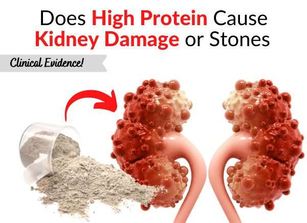 Does High Protein Cause Kidney Damage or Stones  Clinical ...
