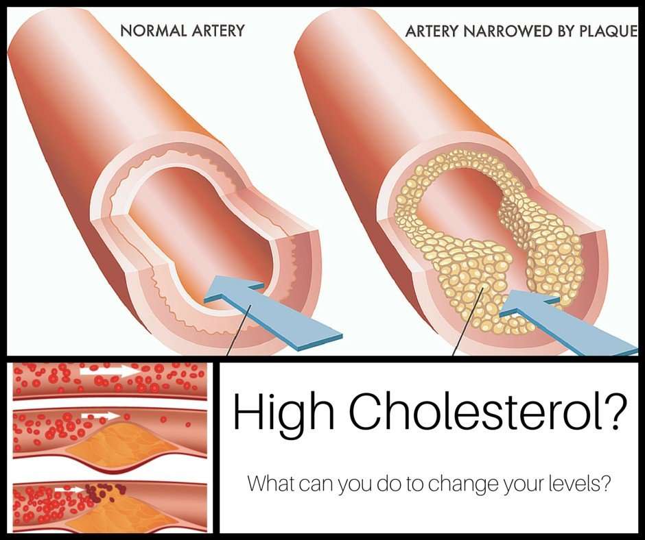 Everything You Need To Know About High Cholesterol ...