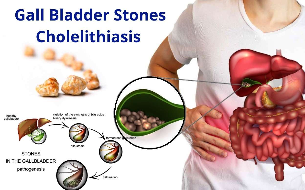 Gallstones cholelithesis Homeopathic Treatment Gall bladder stone ...