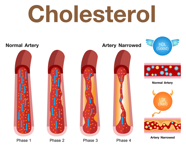 HDL and LDL Cholesterol: Cool Springs Internal Medicine ...