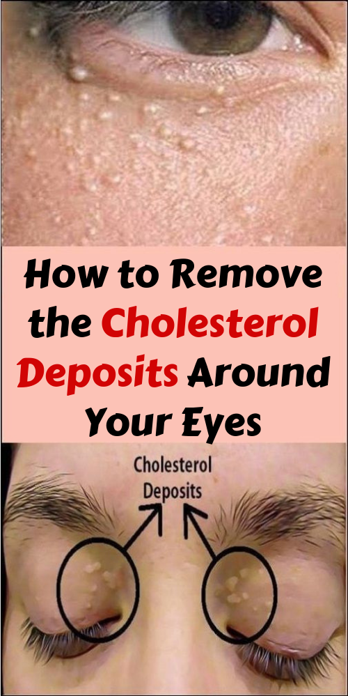 Healthy Discuss: How to Remove the Cholesterol Deposits Around Your Eyes