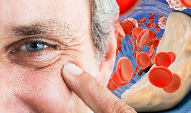 High cholesterol: Symptoms include yellow patches around the eyes ...