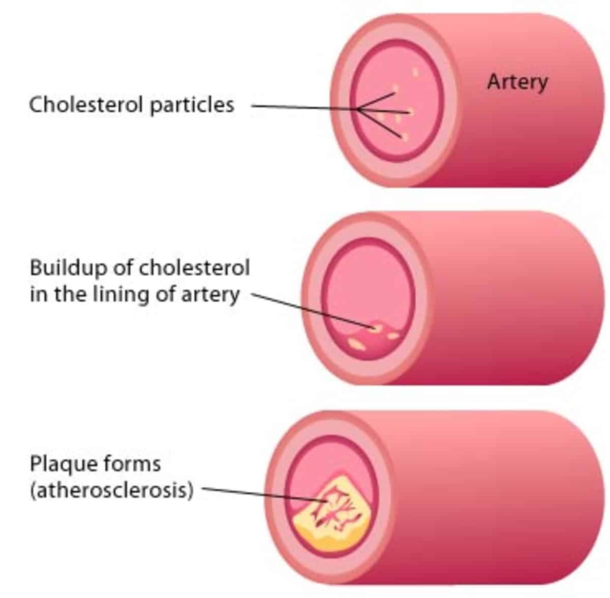 How can I reduce my cholesterol without taking medication?