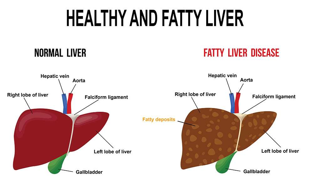 How Much Do You Know Your Liver &  Fatty Liver?