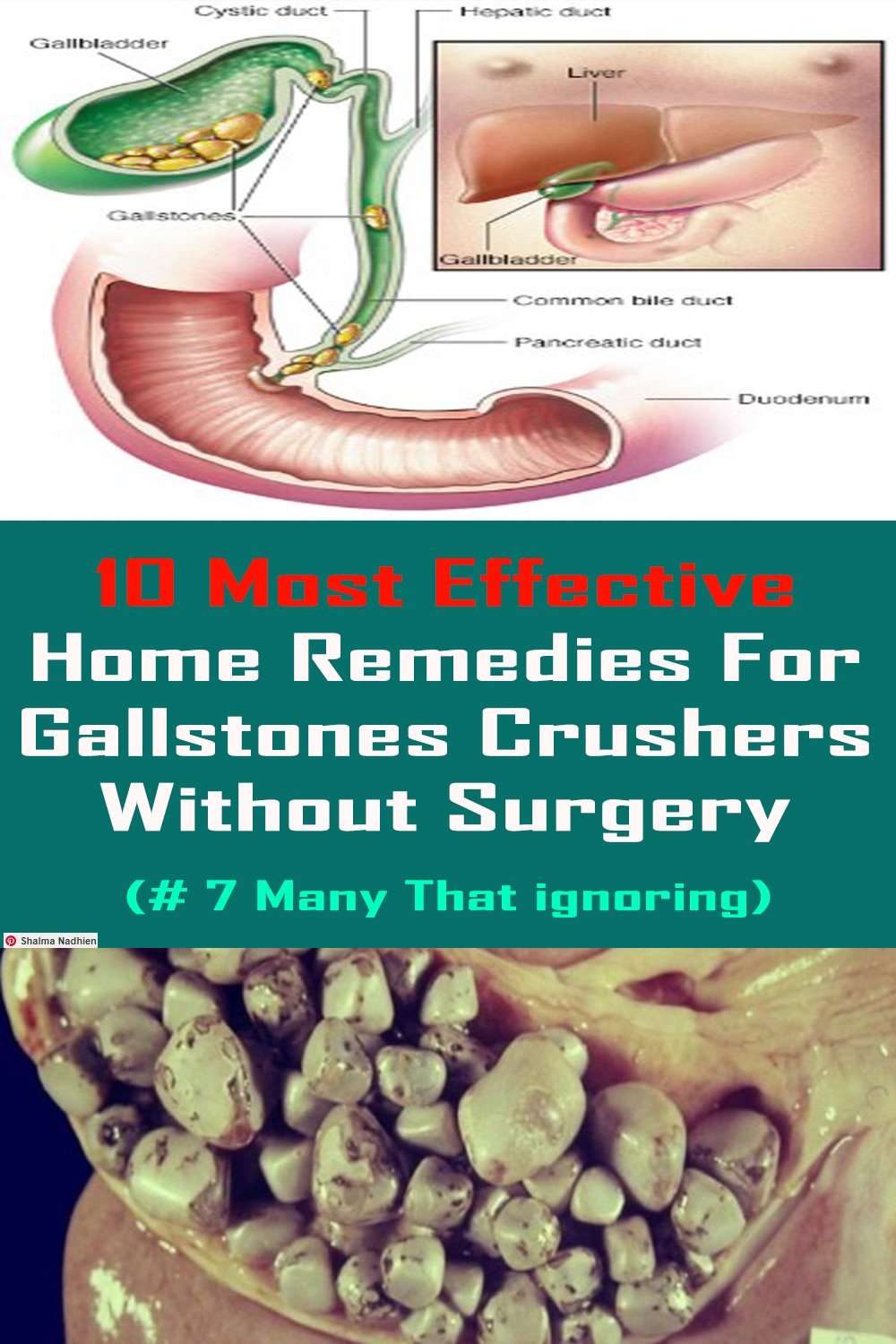 HOW TO DESTROY AND FLUSH ALL GALLSTONES NATURALLY WITHOUT ...