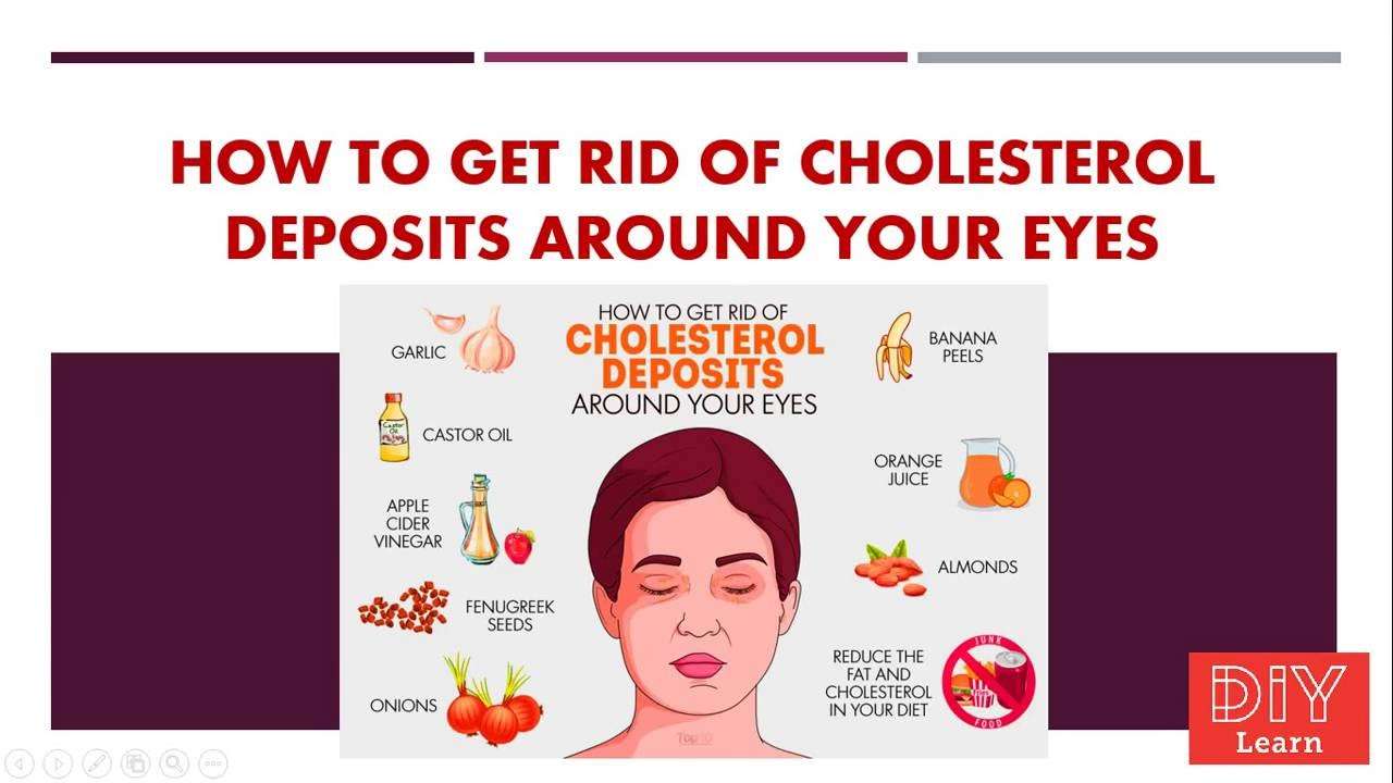 How to Get Rid of Cholesterol Deposits Around