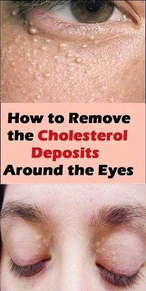 How to Remove the Cholesterol Deposits Around Your Eyes ...