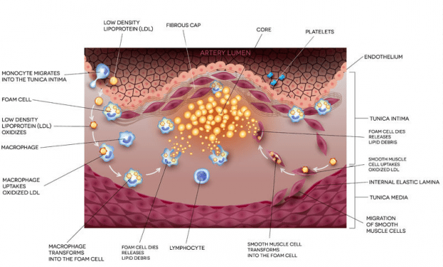 Low Density Lipoprotein (LDL) in Atherosclerosis and Heart ...