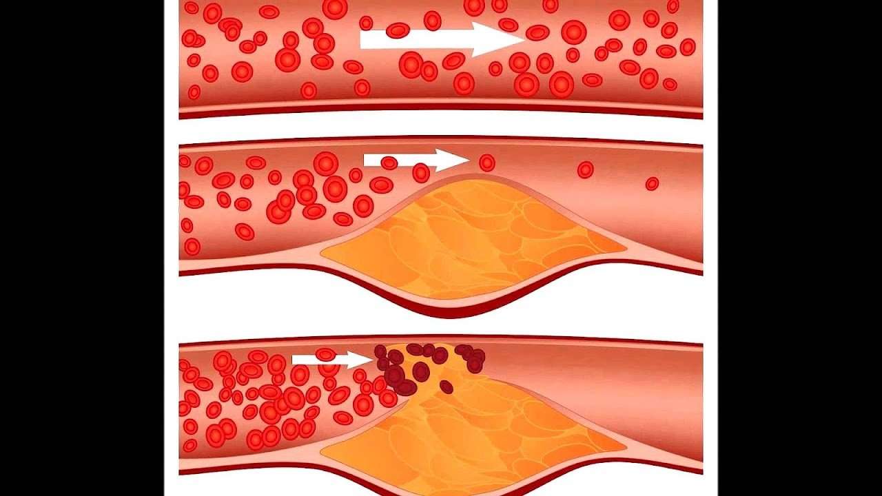 Safest Cholesterol Lowering Medication Medicine