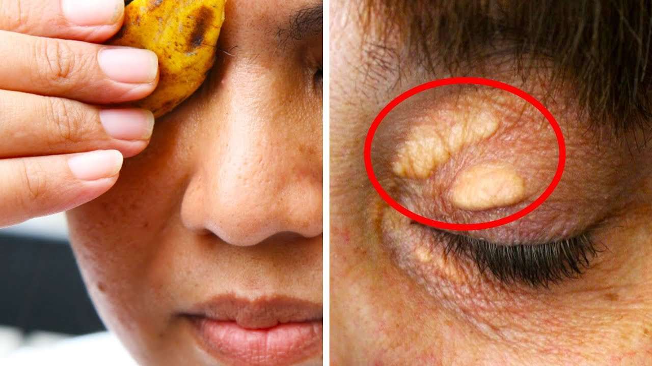 Say Goodbye To Cholesterol Deposits On Your Eyelids And ...