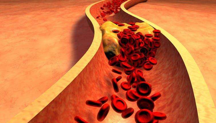 The simple cholesterol test that says if you need statins  and why ...