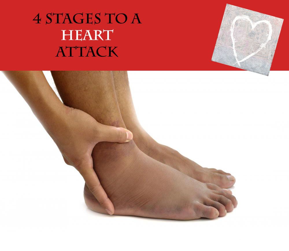 These 4 stages can happen quickly. If you have high cholesterol, you ...