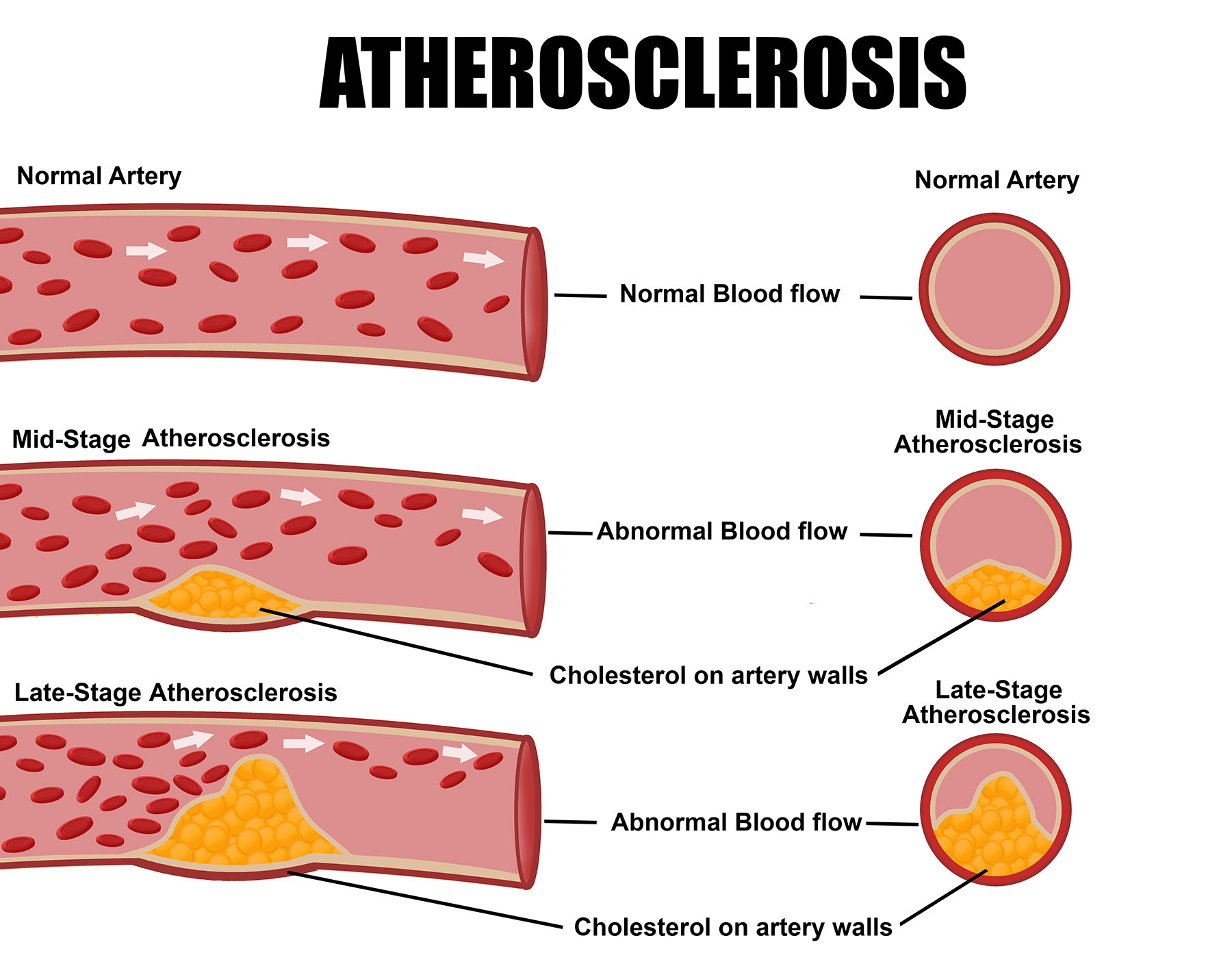 What is Atherosclerosis and its associated risk factors ...