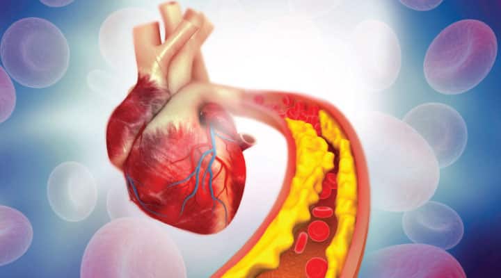 When Does Cholesterol Cause Heart Disease